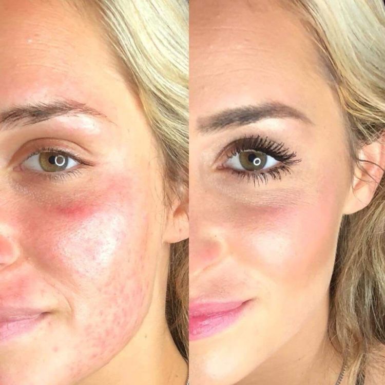 Melissa's foundation result