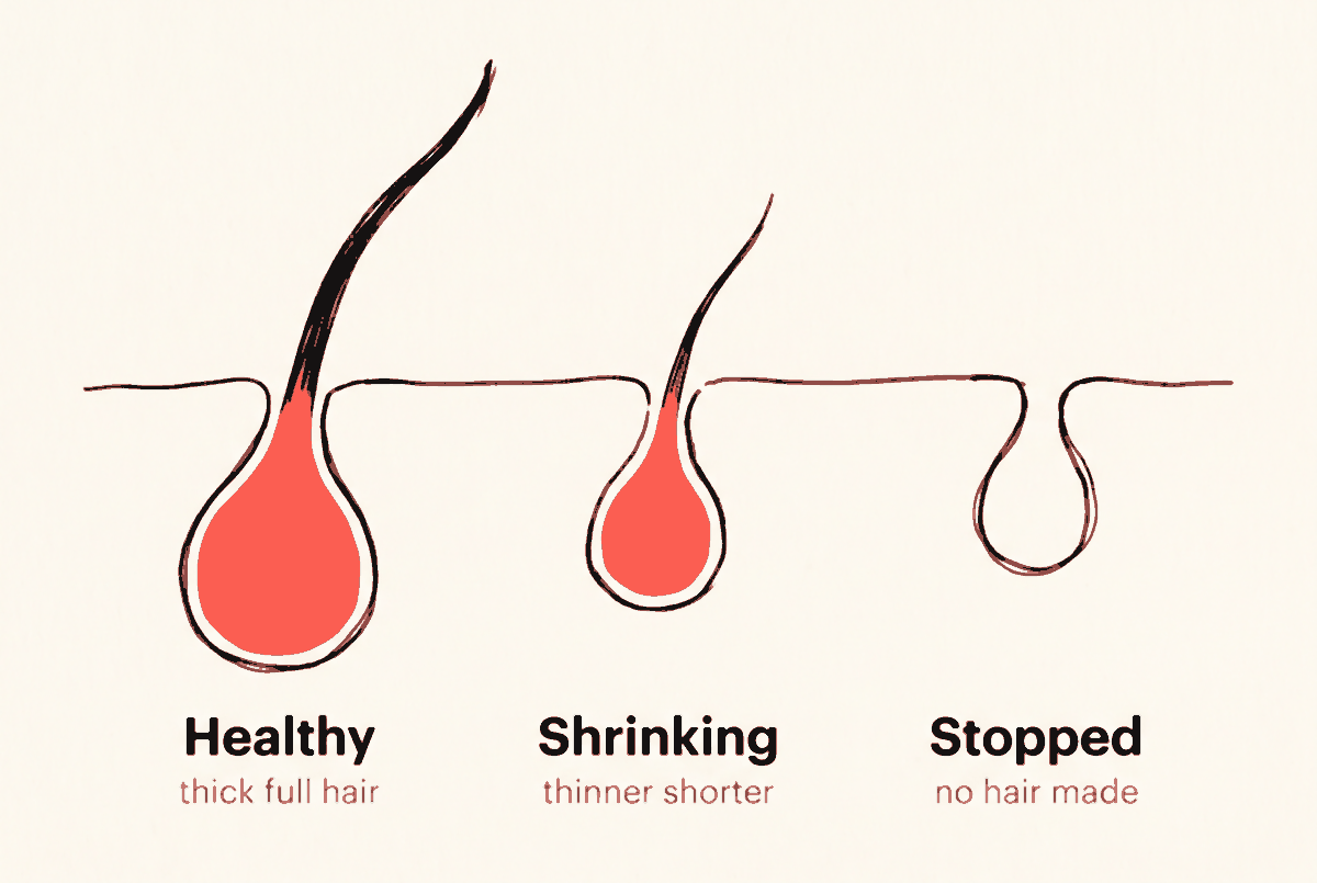Three follicles, each smaller than the last: how DHT shrinks a follicle across growth cycles