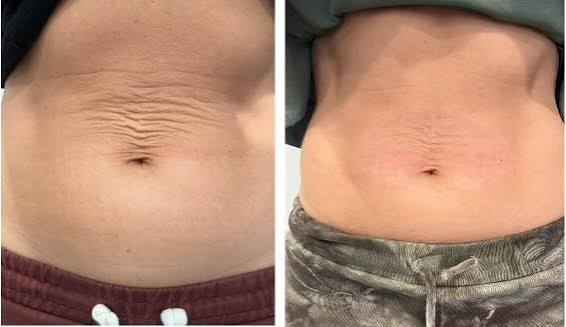 Original customer before-and-after belly photographs supplied by the brand