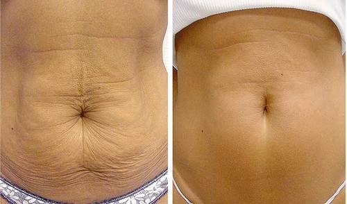 Second unaltered brand-supplied belly before-and-after pair, shown side by side